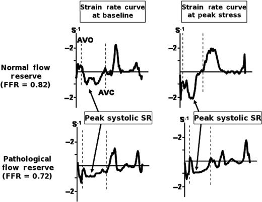 A typical example of the strain rate curves in a patient with normal flow reserve (non-ischaemic group) and in a patient with pathological flow reserve (ischaemic group). Note that the peak systolic strain rate only increases during DSE peak stress in the patient with normal flow reserve. AVC, aortic valve closure; AVO, aortic valve opening; DSE, dobutamine stress echocardiography; FFR, fractional flow reserve; SR, strain rate.