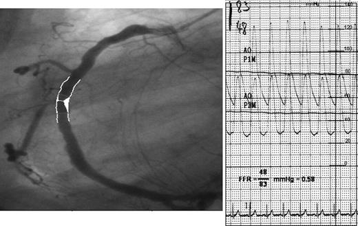 Angiography (left panel) and aortic plus distal coronary pressure (right panel) at maximum hyperaemia induced by intracoronary bolus injection of adenosine in an ischaemic patient. In addition, the calculated fractional flow reserve (0.58) is given.
