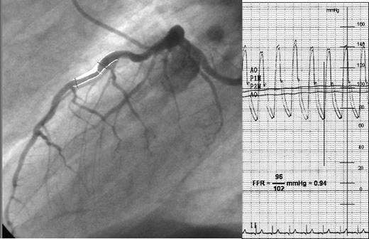 Angiography (left panel) and aortic plus distal coronary pressure (right panel) at maximum hyperaemia induced by intracoronary bolus injection of adenosine in a non-ischaemic patient. In addition, the calculated fractional flow reserve (0.94) is given.