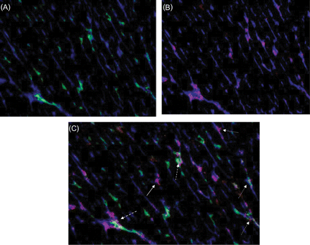 Expression of vascular endothelial growth factor by bone-marrow-derived and non-bone-marrow-derived endothelial cells. (A) Representative fluorescent overlay showing bone-marrow-derived endothelium [endothelium (his 52, blue) bone-marrow-derived cells (hPAP, green)]. (B) Representative fluorescent overlay showing vascular endothelial growth factor expression in the endothelium [endothelium (his 52, blue) vascular endothelial growth factor (red)]. (C) Merged picture of (A) and (B) showing that vascular endothelial growth factor is expressed by bone-marrow-derived (dashed arrow) and non-bone-marrow-derived (solid arrow) endothelial cells.
