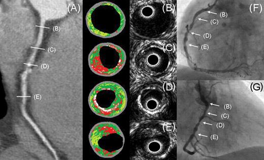  Coronary plaques in the culprit vessel of a patient presenting with unstable angina pectoris: ( A ) Multi-slice computed tomography (MSCT) multiplanar reconstruction of the right coronary artery showing obstructive non-calcified and mixed plaques. ( B ) to ( E ) Grey-scale intravascular ultrasound (IVUS) images and the corresponding VH (virtual histology) IVUS images. In ( B ), small amount of plaque in the proximal right coronary artery is seen, which appears normal on MSCT. TCFA (thin cap fibroatheroma) with a large amount of necrotic core is detected in proximally and distally located non-calcified plaques of the right coronary artery ( C ) and ( E ). A corresponding cross-section of a mixed plaque in the mid-right coronary artery shows plaque with calcium on VH IVUS ( D ). Multiple obstructive stenoses in the right coronary artery were confirmed on invasive coronary angiography ( F ) and ( G ). VH IVUS plaque components: dark green indicates fibrotic tissue; light green, fibro-fatty tissue; red, necrotic core; white, dense calcium. 