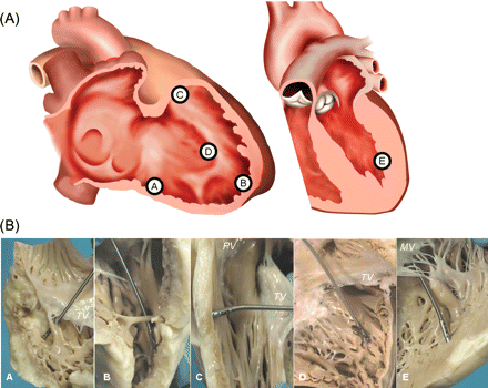 Endomyocardial biopsy sampling sites in the explanted hearts. (A) Graphical representation of the sampling sites in the right ventricular inferior-subtricuspid (A), right ventricular antero-apical (B), right ventricular outflow tract (C), right-sided ventricular septum (D) and the left ventricular free wall (E). (B) Simulated endomyocardial biopsy in vitro in explanted hearts in the corresponding sampling sites (A–E as in Figure 1A). MV, mitral valve; PV, pulmonary valve; TV, tricuspid valve.