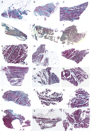 Representative right ventricular (inferior-subtricuspid, apex, right ventricular outflow tract) endomyocardial biopsy samples in the six groups: arrhythmogenic right ventricular cardiomyopathy/dysplasia diffuse forms (A–C); arrhythmogenic right ventricular cardiomyopathy/dysplasia segmental forms (D–F); controls (G–I); adipositas cordis (L–N); dilated cardiomyopathy (O–Q); elderly (R–T).