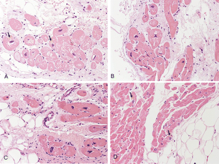 Myocyte abnormalities in right ventricular endomyocardial biopsy samples. Note the presence of hypertrophic myocytes with dysmetric and dysmorphic nuclei, cytoplasmatic vacuolization and perinuclear halo (arrows); small adipocytes and fibroblasts are seen in arrhythmogenic right ventricular cardiomyopathy/dysplasia (A–C). Perinuclear halo (arrows) is also evident in dilated cardiomyopathy: note the focal fatty infiltration (D).