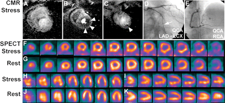An example of a 47-year old patient is shown 2 months after successful stenting of the left anterior descending coronary artery and mild angina. The perfusion-CMR study during hyperemia (at 0.1 mmol/kg Gd-DTPA-BMA) demonstrates a perfusion deficit in the subendocardium of the lateral wall (B/C; arrow heads) appreciated by all three readers (mean score of 13; scores of readers 1–3: 15/9/15). Single-photon emission computed tomography in this patient was positive for the presence of CAD for one reader (mean score: 2; scores of readers 1–3: 0/6/0). Coronary X-ray angiography demonstrated a significant stenosis in the circumflex coronary artery (D, arrow). Perfusion in the anterior wall was assessed correctly by both techniques (normal perfusion) despite a stent in the left anterior descending coronary artery