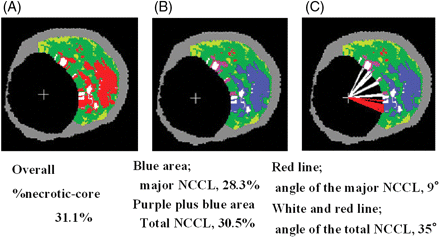 An example of selective quantification of the necrotic core in contact with the lumen (NCCL). (A) The original virtual histology-intravascular ultrasound cross-sectional area. (B) The blue area was selectively quantified as the major confluent NCCL areas and blue plus purple areas indicate total NCCL areas. (C) Measurement of the angle occupied by the total NCCL (white and red line) and the angle occupied by the major confluent NCCL (red line).