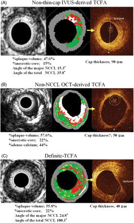 (A) A representative case of non-thin-cap IVUS-derived thin-cap fibroatheroma (TCFA). Virtual histology-IVUS shows 47.6% of %plaque-volume, 15% of %necrotic-core. The angle of the major NCCL was 15.3°, and that of the total NCCL was 35.8°. OCT shows signal-poor lesions with an overlying signal-rich band in the upper right quadrant. A signal-poor lesion indicates a lipid pool and signal-rich band indicates a fibrous cap. The fibrous cap thickness was 90 µm. (B) A representative case of non-NCCL OCT-derived TCFA. OCT identified a fibrous cap thickness of 50 µm which covers the low intensity area, but VH-IVUS did not identify the NCCL. (C) A representative case of definite-TCFA. Virtual histology-IVUS shows %plaque-volume of 55.8% and %necrotic-core of 22%. The angle of the major NCCL was 24.8°, and that of the total NCCL was 100.3°. Its minimum fibrous cap thickness was 40 µm.