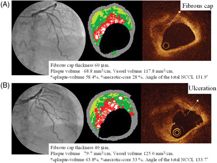 (A) Coronary angiography (CAG) revealed 50% stenosis in the mid-left anterior descending artery in July 2006. VH-IVUS revealed a 68.8 mm3/cm plaque volume, 117.8 mm3/cm vessel volume, 58.4% %plaque-volume, and 28% %necrotic-core. The fibrous cap thickness of this lesion was 60 µm by OCT measurement and this lesion was diagnosed as definite-TCFA. (B) After 6 months, because the patient experienced chest pain at rest with increased frequency, we performed CAG. The CAG revealed 90% stenosis at the site of the previous definite-TCFA lesion. VH-IVUS revealed an increase in plaque volume (68.8→79.7 mm3/cm), vessel volume (117.8→125.0 mm3/cm), %plaque-volume (58.4%→63.8%), and %necrotic-core (28%→33%). OCT revealed ulceration of the fibrous cap.