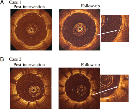 Representative examples of optical coherence tomography-derived cross-sectional images post-intervention and at follow-up demonstrating a well-apposed stent strut with (A) no evidence of intimal covering (case 1); and (B) evidence of intimal hyperplasia (case 2).