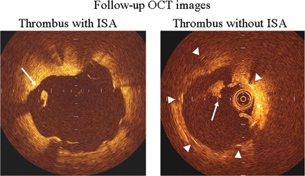 Representative optical coherence tomography-derived cross-sectional image demonstrating thrombus associated with an incompletely apposed stent strut (left panel) as well as thrombus associated without incompletely apposed stent strut (right panel). White long arrow indicates thrombus (left and right panels) and triangles demonstrate stent struts (right panel).