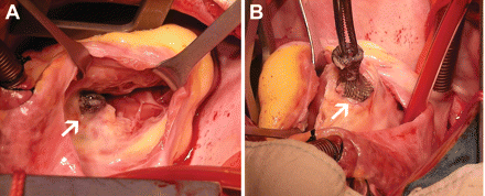 Removal of the perimembranous ventricular septal defect occluder in a 13-year-old boy 746 days post-intervention due to moderate tricuspid insufficiency. (A) The tricuspid valve was encroached upon by the occluder, leading to moderate tricuspid insufficiency; (B) The Shanghai perimembranous ventricular septal defect occluder was explanted, and the perimembranous ventricular septal defect was repaired.