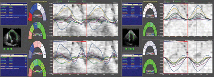 Two-dimensional speckle-tracking imaging in the apical four-chamber view in a patient before (left panel) and after cardiac resynchronization therapy-defibrillator implantation (right panel). Upper curves represent transverse strain curves, which were used to measure left ventricular dyssynchrony and lower curves represent longitudinal strain that were used to measure contractile function. Improvement in left ventricular dyssynchrony and left ventricular contractile function was shown at follow-up.