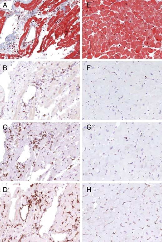 Typical histopathological findings in borderline myocarditis (A–D) and uninflamed hearts (E–H). Masson's trichrome staining is shown in (A) and (E). Examples of immunohistochemical staining showing CD3+ T lymphocytes (B and F), CD 68+ macrophages (C and G), and expression of HLA class II molecules (D and H).