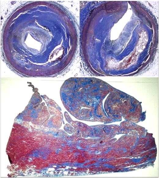 Sudden death of a middle-aged athlete. Obstructive atherosclerotic coronary artery disease of both left (anterior descending branch) and right coronary arteries (A and B). Histology of the myocardium shows replacement type fibrosis due to previous myocardial infarction (C). Heidenhain trichrome.