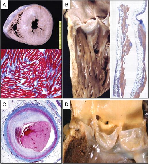Leading causes of sudden cardiovascular death in young competitive athletes. (A) Hypertrophic cardiomyopathy: short-axis cut of the heart specimen showing asymmetric septal hypertrophy with multiple septal scars (top); histology of the interventricular septum revealing typical myocardial disarray with interstitial fibrosis (bottom) (Heidenhain trichrome); (B) Arrhythmogenic right ventricular cardiomyopathy: section of the heart specimen along the right ventricular infundibulum (left); panoramic histological view of the right infundibular free wall showing wall thinning with fibro-fatty replacement (right) (Heidenhain trichrome); (C) Atherosclerotic coronary artery disease: histology of the proximal tract of the left anterior descending coronary artery showing a non-obstructive fibrous plaque complicated by luminal thrombosis due to endothelial erosion (Heidenhain trichrome); (D) Congenital coronary anomaly: gross view of the aortic root showing both coronary ostia located in the right coronary sinus, with left coronary artery arising from the right aortic sinus of Valsalva and running between the aorta and the pulmonary trunk.