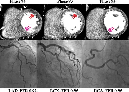 Motion artefacts. Seventy-eight-year-old lady for investigation of chest pain on background of type 2 diabetes. Fractional flow reserve of all three major epicardial vessels were not significant. On computed tomography myocardial perfusion imaging, the mid-axial cuts demonstrate apparent perfusion abnormalities in the anterolateral wall in phase 74 (red arrows), not present in phase 83. Similarly apparent perfusion abnormalities are present in the inferoseptal wall in phase 95 (blue arrows), yet absent in phase 74. ‘Shifting perfusion abnormalities’ which are not seen on all phases are secondary to artefacts. In this case, this may be secondary to contrast enhancement of the left ventricle or motion. The heart rate during computed tomography myocardial perfusion imaging was 80 b.p.m.