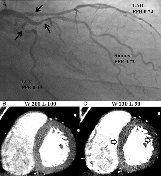Example of inadequate window width and level resulting in false negative territories. (A) Invasive angiography demonstrate significant stenoses in the proximal left anterior descending artery, Ramus, and left circumflex arteries (black arrows). (B) and (C) Computed tomography perfusion images displayed in the mid-axial cuts demonstrate no perfusion defects using settings W200/L100 which become apparent at W130/L90 (white arrows).