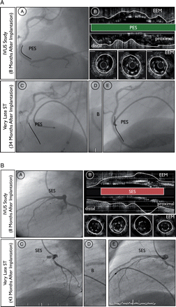 Examples of very late ST in patients with incidental incomplete stent apposition documented at 8-month angiographic follow-up. (A) Angiographic and (B) intravascular ultrasound findings at the 8-month follow-up (C) angiographic findings before, (D) during and (E) at the end of the revascularization procedure at the time of very late ST. (A) Angiographic and intravascular ultrasound findings 8 months after primary PCI with implantation of paclitaxel-eluting stent in the right coronary artery of a 53-year-old male treated for acute inferior ST-elevation MI. The clinical follow-up was complicated by very late ST 34 months after the index procedure (26 months after angiographic follow-up). (B) Angiographic and intravascular ultrasound findings 8-month after PCI with implantation of sirolimus-eluting stunt in the left anterior descending artery of a 43-year-old male treated for a non-ST elevation MI. The clinical follow-up was complicated by very late ST 43 months after the index procedure (35 months after angiographic follow-up). EEM, external elastic membrane; IVUS, intravascular ultrasound; PES, paclitaxel-eluting stent; SES, sirolimus-eluting stent; ST, stent thrombosis.