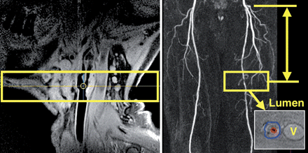 Magnetic resonance imaging method for serial plaque imaging. Left: sagittal high spatial resolution magnetic resonance imaging image at the level of the carotid bifurcation shows an extensive atherosclerotic plaque with positive remodelling of the internal and common carotid artery (T1-weighted, double inversion recovery). The yellow box indicates the positioning of subsequent axial high spatial resolution magnetic resonance imaging sequences. Right: magnetic resonance imaging method for serial plaque imaging at the femoral level. After localization of the stenosis of interest, a three-dimensional volume (yellow box), containing 10 contiguous cross-sectional images perpendicular to the lumen axis was acquired and carefully matched over time using measurements from anatomical landmarks (such as common femoral artery bifurcation). Manual tracing of vessel border (lumen in red and outer border in blue) was performed to quantify vessel dimensions (lower panel). Outer vessel border defined the total vessel area. V, Femoral vein.