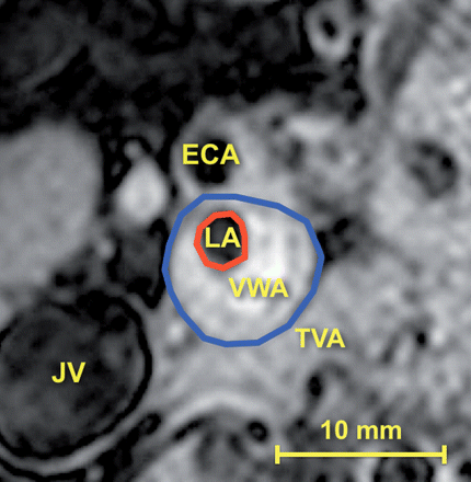 Carotid artery tracing. Atheromatous plaque of the internal carotid artery: lumen area (LA, red line) and total vessel area (TVA, blue line) are manually outlined. Vessel wall area (VWA = TVA − LA) is calculated by the software. Also note the external carotid artery (ECA) and the right jugular vein (JV).