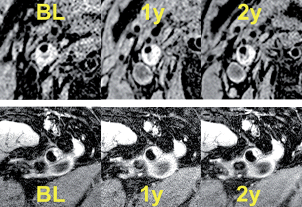 Example magnetic resonance images of both territories. Top: axial magnetic resonance images (T1-weighted, double inversion recovery) at the level of the internal carotid artery at BL; 1- and 2-year follow-up shows a negative remodelling with moderate luminal narrowing. Bottom: axial oblique plane high spatial resolution magnetic resonance imaging images of the common femoral artery (three-dimensional-T1-weighted-double inversion recovery) of the same patient showing eccentric atherosclerotic remodelling at baseline and at 1- and 2-year follow-up.
