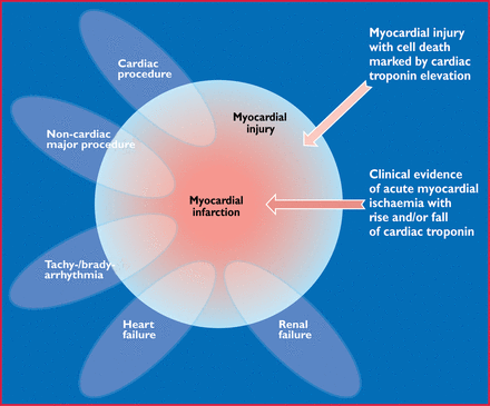 This illustration shows various clinical entities: for example, renal failure, heart failure, tachy- or bradyarrhythmia, cardiac or non-cardiac procedures that can be associated with myocardial injury with cell death marked by cardiac troponin elevation. However, these entities can also be associated with myocardial infarction in case of clinical evidence of acute myocardial ischaemia with rise and/or fall of cardiac troponin.