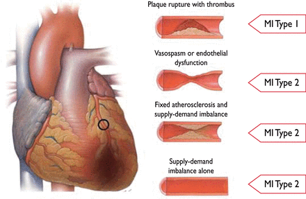 Differentiation between myocardial infarction (MI) types 1 and 2 according to the condition of the coronary arteries.