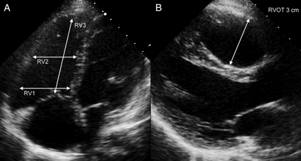Measurement of right ventricular (RV) dimensions using echocardiography ...