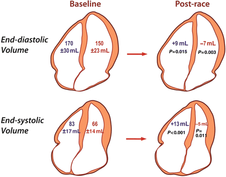 Differential effect of prolonged intense exercise on right and left ventricular volumes. Baseline volumes are shown on the left and the changes in volume post-race are shown on the right. Right ventricular volumes increased in the post-race setting while left ventricular volumes decreased resulting in a decrease in right ventricular ejection fraction but not left ventricular ejection fraction.