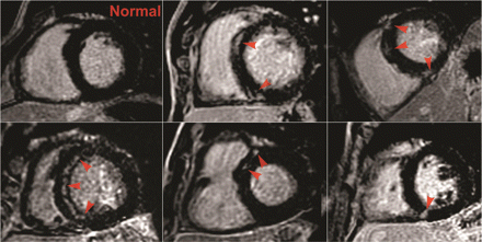 Delayed gadolinium enhancement in five athletes. Images of five athletes in whom focal delayed gadolinium enhancement (DGE) was identified in the interventricular septum (indicated with arrows) when compared with an athlete with a normal study (top left).