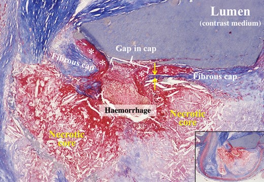 Cross-sectioned coronary artery showing a ruptured thin-cap fibroatheroma. The fibrous cap is very thin near the rupture site (between arrows) and a non-obstructive mural thrombus (asterisks) is bordering the gap in the disrupted cap. A haemorrhage has penetrated from the lumen through the gap into the lipid-rich necrotic core in which the characteristic cholesterol clefts are clearly seen. The lumen contains contrast medium injected postmortem. Overview in inset. Trichrome, staining collagen blue, and thrombus and haemorrhage red.