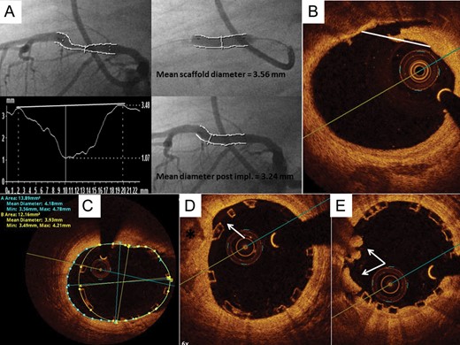 Quantitative coronary angiography and optical coherence tomography measurements. (A) Quantitative coronary angiography measurements before bioresorbable vascular scaffold implantation, during balloon inflation and immediately post-implantation. Acute elastic recoil 9%. (B) Edge dissection by OCT, the maximal length of dissection is compared with artery circumference. (C) Moderately large incomplete scaffold apposition due to large vessel calibre at proximal scaffold edge. (D) Small incomplete scaffold apposition most likely due to vessel calcification (asterisk). (E) Small protruding thrombi, excellent scaffold apposition.