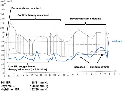 Ambulatory 24 h blood pressure (BP) monitoring in a patient with newly diagnosed obstructive sleep apnoea. Note the reverse nocturnal dipping and the increased heart rate (HR) during nighttime, possibly due to exaggerated sympathetic nervous system activity.