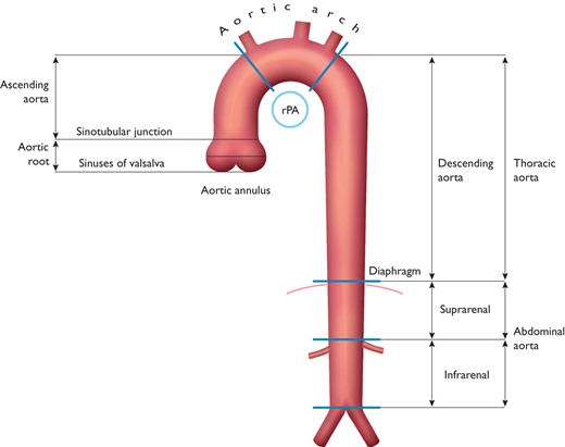 Segments of the ascending and descending aorta. rPA = right pulmonary artery.