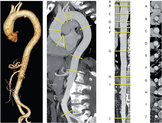 Thoracic and abdominal aorta in a three-dimensional reconstruction (left lateral image), parasagitale multiplanar reconstruction (MPR) along the centreline (left middle part), straightened-MPR along the centreline with given landmarks (A–I) (right side), orthogonal to the centreline orientated cross-sections at the landmarks (A–J). Landmarks A–J should be used to report aortic diameters: (A) sinuses of Valsalva; (B) sinotubular junction; (C) mid ascending aorta (as indicated); (D) proximal aortic arch (aorta at the origin of the brachiocephalic trunk); (E) mid aortic arch (between left common carotid and subclavian arteries); (F) proximal descending thoracic aorta (approximately 2 cm distal to left subclavian artery); (G) mid descending aorta (level of the pulmonary arteries as easily identifiable landmarks, as indicated); (H) at diaphragm; (I) at the celiac axis origin; (J) right before aortic bifurcation. (Provided by F Nensa, Institute of Diagnostic and Interventional Radiology, Essen.)