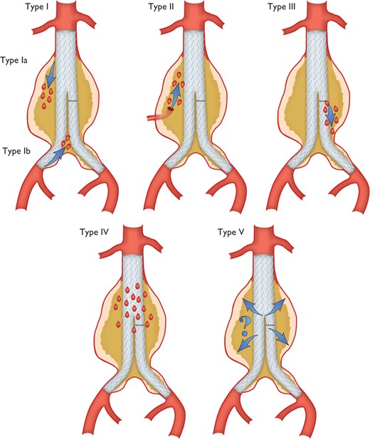 Classification of endoleaks.
Type I:  Leak at graft attachment site above, below, or between graft components (Ia: proximal attachment site; Ib: distal attachment site).
Type II: Aneurysm sac filling retrogradely via single (IIa) or multiple branch vessels (IIb).
Type III: Leak through mechanical defect in graft, mechanical failure of the stent-graft by junctional separation of the modular components (IIIa), or fractures or holes in the endograft (IIIb).
Type IV: Leak through graft fabric as a result of graft porosity.
Type V: Continued expansion of aneurysm sac without demonstrable leak on imaging (endotension, controversial).
(Modified from White GH, May J, Petrasek P. Semin Interv Cardiol. 2000;5:35–46107).
