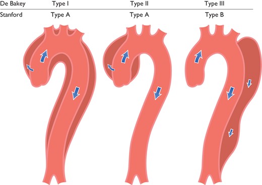 Classification of aortic dissection localization. Schematic drawing of aortic dissection class 1, subdivided into DeBakey Types I, II, and III.1 Also depicted are Stanford classes A and B. Type III is differentiated in subtypes III A to III C. (sub-type depends on the thoracic or abdominal involvement according to Reul et al.140)