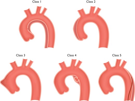 Classification of acute aortic syndrome in aortic dissection.1,141 Class 1: Classic AD with true and FL with or without communication between the two lumina.
Class 2: Intramural haematoma.
Class 3: Subtle or discrete AD with bulging of the aortic wall.
Class 4: Ulceration of aortic plaque following plaque rupture.
Class 5: Iatrogenic or traumatic AD, illustrated by a catheterinduced separation of the intima.