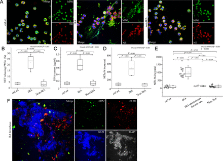 Polymorphonuclear neutrophils of patients with ST-segment elevation acute myocardial infarction release neutrophil extracellular traps at the site of plaque rupture. (A) Neutrophil extracellular traps of polymorphonuclear neutrophils obtained from infarct-related coronary artery, non-infarct-related coronary artery, and control individual coronary arteries/ctrl art (confocal microscopy). (B) Percentage of neutrophil extracellular trap-releasing polymorphonuclear neutrophils, (C) extracellular deoxyribonucleic acid levels, (D) myeloperoxidase–deoxyribonucleic acid complex in isolated neutrophil extracellular trap structures obtained by selective coronary sampling. (E) Myeloperoxidase–deoxyribonucleic acid complex levels in plasma samples obtained from coronary arteries of ST-segment elevation acute myocardial infarction patients and control individuals (least significant difference test was used only in E). (F) Neutrophil extracellular traps visualized in thrombus specimens from patients with ST-segment elevation acute myocardial infarction as extracellular structures decorated with myeloperoxidase and citrulinated H3 (confocal microscopy). Green: myeloperoxidase; red: (A) NE, (F) cit-H3; blue: 4′,6-diamidino-2-phenylindole/deoxyribonucleic acid. One representative out of six (A) or nine (F) independent experiments is shown. Original magnification: (A) ×600, (F) ×400. Scale bar: 5 μm. Box edges for chart boxes of all figures demonstrate mean ± SD. For (B), (C), (D), n = 6.