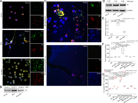 Functional tissue factor is localized in neutrophil extracellular traps generated in infarct-related coronary artery of patients with ST-segment elevation acute myocardial infarction. (A) Localization of tissue factor in polymorphonuclear neutrophils obtained after selective coronary sampling, (confocal microscopy). (B) Tissue factor immunoblotting and integrated optical density of neutrophil extracellular trap proteins. (C) Tissue factor on neutrophil extracellular traps in thrombi specimens from patients with ST-segment elevation acute myocardial infarction, is co-localized with NE extracellularly, (confocal microscopy). Green: tissue factor; red: NE; blue: 4′,6-diamidino-2-phenylindole/deoxyribonucleic acid. One representative out of six (A) or nine (C) independent experiments is shown. Original magnification: ×600. Scale bar: 5 μm. (D) Tissue factor immunoblotting and integrated optical density ratio of tissue factor to glyceraldehyde 3-phosphate dehydrogenase in polymorphonuclear neutrophil lysates. (B), (D) One representative out of three independent experiments is shown. (E) Tissue factor messenger ribonucleic acid expression in polymorphonuclear neutrophils (n = 6) obtained by selective coronary sampling. (F) Thrombin levels in control plasma incubated with isolated neutrophil extracellular trap structures from polymorphonuclear neutrophils obtained by selective coronary sampling. Neutralizing anti-tissue factor antibody was used to inhibit tissue factor-mediated thrombin generation. DNase was used for neutrophil extracellular trap scaffold degradation. Phorbol myristate acetate-induced neutrophil extracellular trap structures in control polymorphonuclear neutrophils were used as negative control. (G) Fluorescence-activated cell-sorting analysis of Annexin V and CD62P in control platelets stimulated with control plasma pre-treated with isolated neutrophil extracellular trap structures from polymorphonuclear neutrophils obtained by selective coronary sampling. FLLRN peptide was used as a PAR-1 antagonist. For (F) and (G) n = 4.