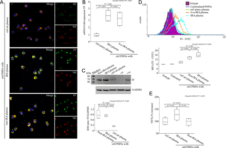 The microenvironment in infarct-related coronary artery induces tissue factor expression but not neutrophil extracellular trap generation in polymorphonuclear neutrophils. (A) Neutrophil extracellular trap generation in control polymorphonuclear neutrophils treated with infarct-related coronary artery plasma, non-infarct-related coronary artery plasma, and plasma obtained from control individuals (confocal microscopy). Green: tissue factor; red: NE; blue: 4′,6-diamidino-2-phenylindole/deoxyribonucleic acid. One representative out of four independent experiments is shown. Original magnification: ×600. Scale bar: 5 μm. (B) Tissue factor mRNA, (C) tissue factor immunoblotting and integrated optical density according to glyceraldehyde 3-phosphate dehydrogenase, and (D) fluorescence-activated cell-sorting analysis with relative MFIs in control polymorphonuclear neutrophils treated with plasma obtained by selective coronary sampling. (C) Unstimulated polymorphonuclear neutrophils and lipopolysaccharide-stimulated peripheral blood mononuclear cells were used as negative and positive controls for tissue factor, respectively. One representative out of four independent experiments is shown. (E) Myeloperoxidase–deoxyribonucleic acid complex in isolated neutrophil extracellular trap structures from control polymorphonuclear neutrophils treated with plasma obtained by selective coronary sampling. For (B), (C), (D), (E) n = 4.
