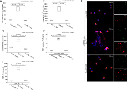 Activated platelets from infarct-related coronary artery are responsible for neutrophil extracellular trap generation. Fluorescence-activated cell-sorting analysis of Annexin V (A) and CD62P (B) on infarct-related coronary artery platelets, non-infarct-related coronary artery platelets and control individual coronary artery platelets. (C) Platelet/polymorphonuclear neutrophil aggregates observed as double-positive CD61/CD66b per 10 000 CD66b positive events with fluorescence-activated cell-sorting analysis in polymorphonuclear neutrophils isolated after selective coronary sampling. (D) Percentage of neutrophil extracellular trap-releasing polymorphonuclear neutrophils and (E) Neutrophil extracellular trap generation by control polymorphonuclear neutrophils treated with platelets isolated after selective coronary sampling, (confocal microscopy). Green: tissue factor; red: NE; blue: 4′,6-diamidino-2-phenylindole/deoxyribonucleic acid. Original magnification: ×600. Scale bar: 5 μm. (F) myeloperoxidase–deoxyribonucleic acid complex in isolated neutrophil extracellular trap structures of control polymorphonuclear neutrophils treated with platelets obtained by coronary sampling. (A), (B), (C), (D), (F) n = 4. (E) One representative out of four independent experiments is shown.