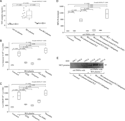 Elevated levels of thrombin in plasma from infarct-related coronary artery are responsible for the local activation of platelets and subsequent neutrophil extracellular trap generation. (A) Thrombin levels in plasma obtained by selective coronary sampling (n = 9, each), as assessed by TAT complex enzyme-linked immunosorbant assay. Fluorescence-activated cell-sorting analysis of Annexin V (B) and CD62P (C) on control platelets treated with plasma from infarct-related coronary artery in the presence or not of thrombin (antithrombin III or dabigatran) and PAR-1 signalling (FLLRN) inhibitors. Recombinant thrombin was used as positive control. (D) Myeloperoxidase–deoxyribonucleic acid complex enzyme-linked immunosorbant assay in neutrophil extracellular traps derived after stimulation of control polymorphonuclear neutrophils with plasma from infarct-related coronary artery of ST-segment elevation acute myocardial infarction patients and control platelets pre-treated with infarct-related coronary artery plasma, in the presence or absence of thrombin inhibitors (antithrombin III or dabigatran). (E) Immunoblotting and integrated optical density of tissue factor in neutrophil extracellular trap proteins derived from in vitro stimulation of control polymorphonuclear neutrophils, as described previously in (D), in the presence or absence of dabigatran. One representative out of four independent experiments is shown. For (B), (C), (D), n = 4.