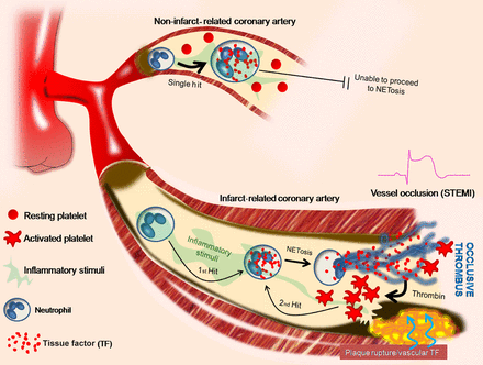 Two ‘hit’ tissue factor/neutrophil extracellular trap model in ST-segment elevation acute myocardial infarction. Schematic representation. Platelets are activated by thrombin in infarct-related coronary artery and interact with polymorphonuclear neutrophils, resulting in neutrophil extracellular traps formation (second step) and exposure of pre-existing tissue factor in polymorphonuclear neutrophils (first step).