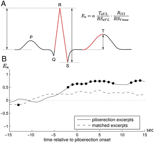 Effects of music on regional activity of the heart. (A) In addition to heart rate and heart rate variability, new approaches investigate effects of music on the regional activity of the heart as reflected in the amplitudes of ECG waves. For example, the computation of the ECG amplitudes indicated in red according to the formula shown in the right panel results in a value (Eκ) shown to be associated with flattened emotionality (low Eκ values correspond to flattened emotionality).6,46 (B) During frissons with piloerection (evoked by music and film clips) Eκ values transiently increase (solid line) compared with when no frisson is experienced during the same stimuli (dashed line, black filled circles indicate significant differences from zero, 568 piloerection incidences were recorded from 25 individuals, Eκ was not correlated with HR).26 The increase in Eκ during frissons reflects changes in the regional activity of the heart.