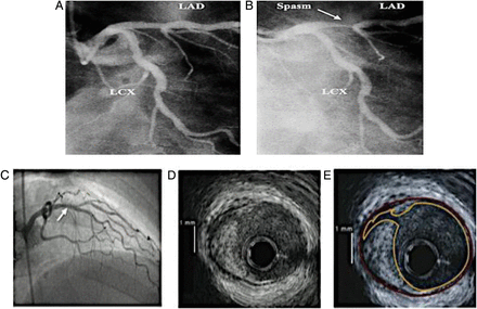 Epicardial causes of MINOCA. (A and B) Acute coronary artery spasm of the left anterior descending coronary artery (LAD) (white arrow) induced by intra-coronary ergonovine test. (C–E) Representative angiographic and intra-vascular ultrasound (IVUS) of plaque disruption. The site of plaque rupture or ulceration is marked with an arrow (C); the right side for the IVUS image (E) shows the outline of the luminal border (yellow) and external elastic lamina (red) corresponding to the IVUS image on left side (D).