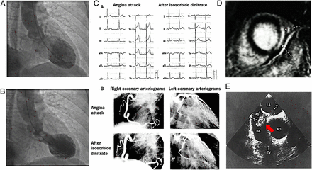 Microvascular causes of myocardial infarction with no obstructive coronary atherosclerosis. (A and B) Takotsubo syndrome during diastole (A) and systole (B). (C) Spontaneous ST segment elevation and angina in the absence of epicardial spasm relieved by nitrate administration in a patient with coronary microvascular spasm. (D) Late gadolinium-enhanced (LGE) imaging in a patient with myocarditis; typical pattern of hyper-enhanced areas (dotted arrows), suggesting fibrotic tissue in the mid-inferolateral segments in short-axis orientation. (E) Thrombus (red arrow) in transit through a patent foramen ovale at two-dimensional transoesophageal echocardiography. (Ao, aorta; TV, tricuspid valve; LA, left atrium; RA, right atrium).