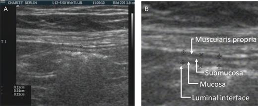 Measurement of bowel wall thickness by two-dimensional sonography. (A) Wall thickness measurement in the terminal ileum (longitudinal section). (B) Detailed cut-out showing four layers of different echogenicity.