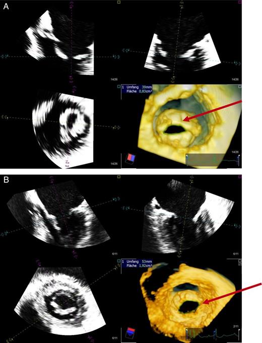 By means of three planes (black and white inlets) a three-dimensional picture of the mitral valve area can be measured from the left ventricular side. In (A) the mitral valve area is shown before percutaneous balloon mitral annuloplasty (MVA = 0.82) (see arrow). In (B), the mitral valve area is shown after PBMP (MVA = 1.92) (see arrow). MVA, mitral valve opening area in cm2; LV, left ventricle; PBMA, percutaneous balloon mitral annuloplasty.
