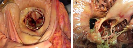 The picture shows a postmortem specimen of a Sapien XT 26 mm valve implantated from the left atrium in a native calcified mitral stenosis (A) from the left atrium side, (B) from the left ventricular side, remarkable is the protrusion of the anterior mitral leaflet into the left ventricular-outflow tract (in aortic position is an old BS mechanical valve implanted surgical 21 years before) (courtesy of H.R.F.).